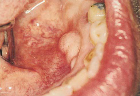 Torus Mandibularis Ct