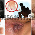 Cara Praktis dan Aman Obati Wasir Dg Obat Herbal thumbnail