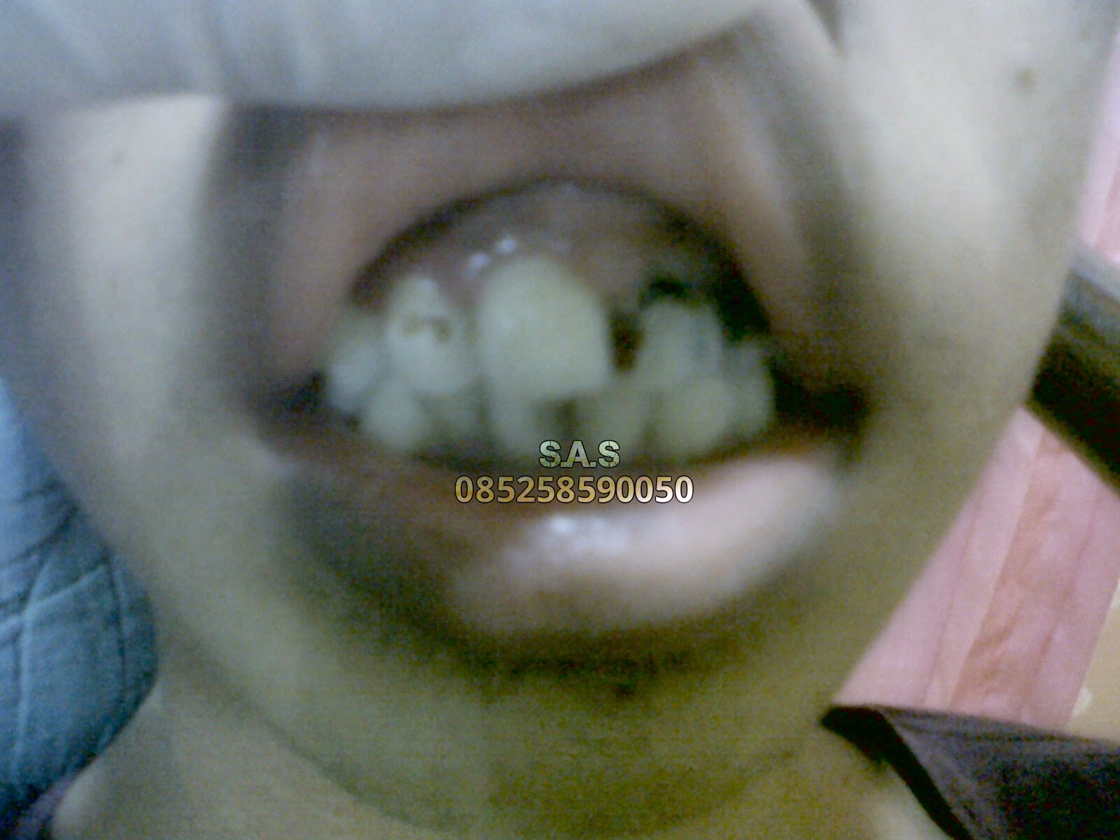 Foto / Gambar Perbaikan Gigi Depan Hitam dan Keropos ...