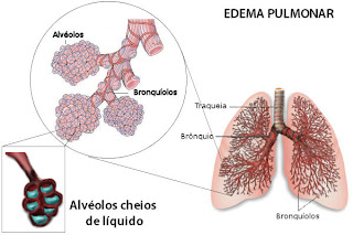 Edema pulmonar agudo