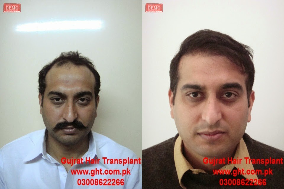 Fue Hair Transplant Cost In Lahore Pakistan Best Fue Hair