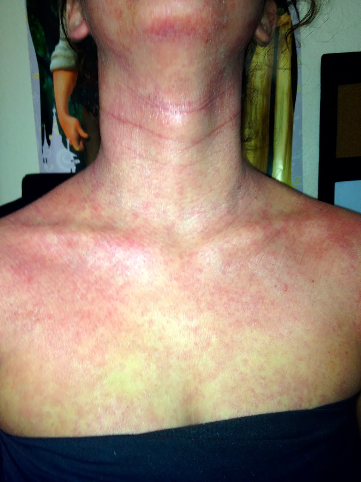 Scratching the Surface of Topical Steroid Withdrawal Day 33Coconut Oil