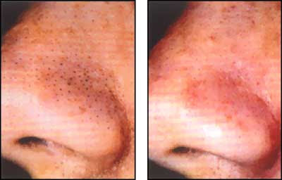 Black Head Remover