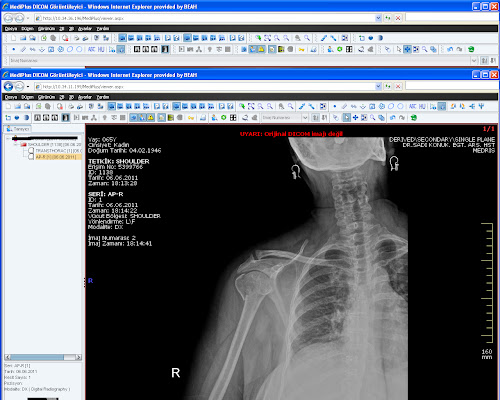 Humeral Fracture Humeral Head Fracture-1.bp.blogspot.com