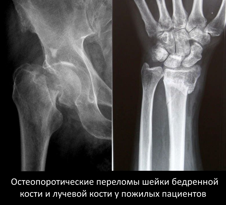 Перелом позвоночника диета Перелом позвоночника диета