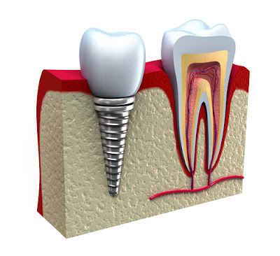Picture of dental implant