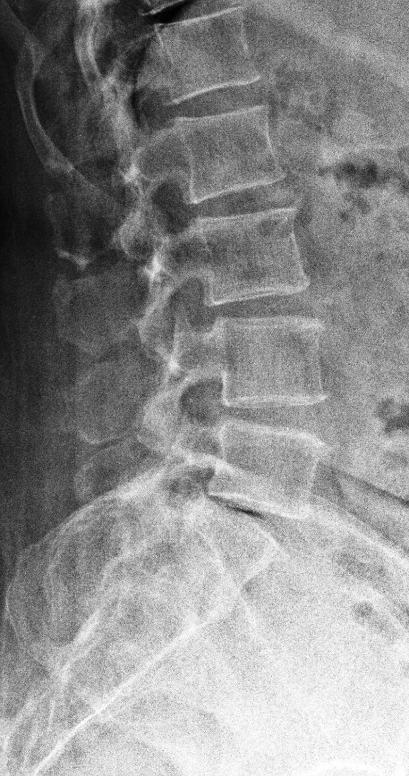 lumbar spine