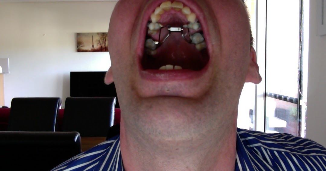 Jaw Surgery Journey The expander is in!