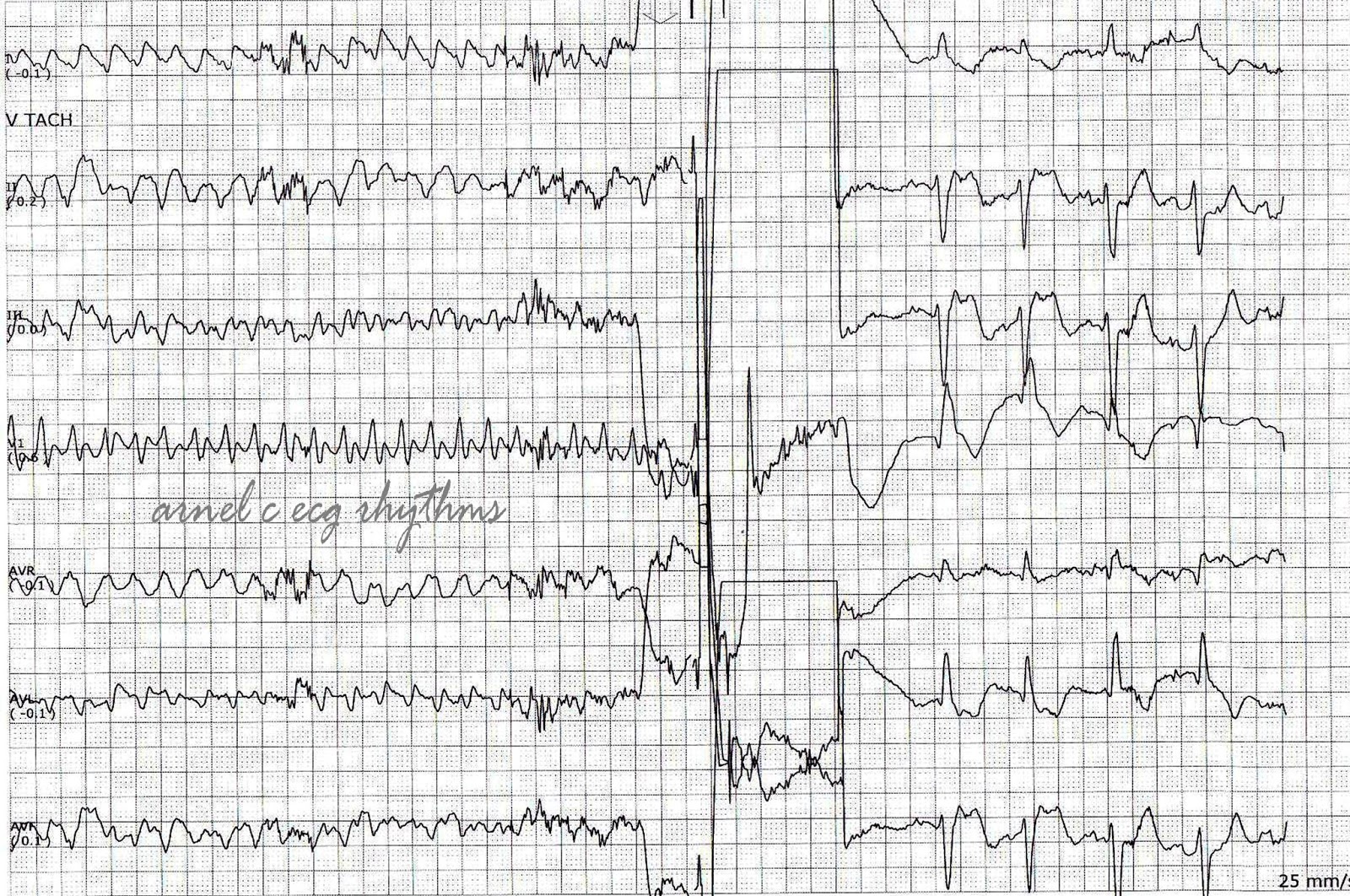 ECG Rhythms Antitachycardia pacing + AICD firing