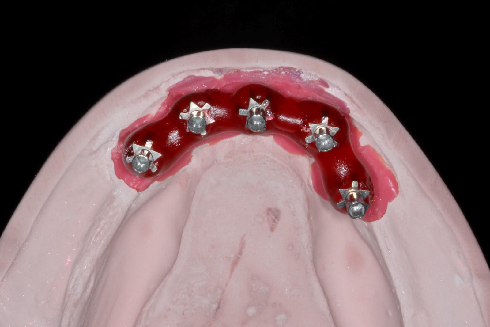 Boise Idaho Prosthodontics Verification Jig Fabrication for Mandibular