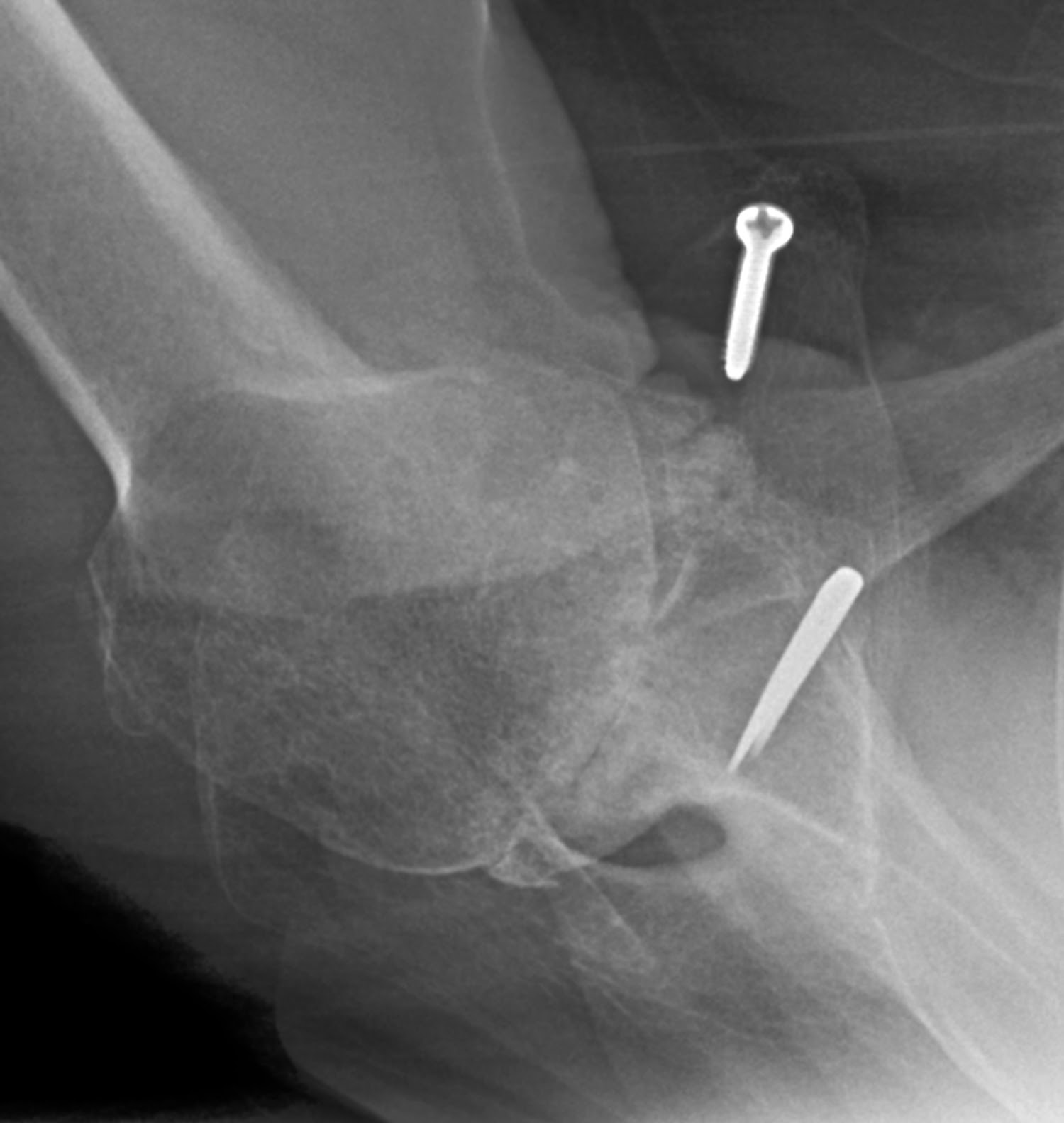 Shoulder Arthritis / Rotator Cuff Tears causes of