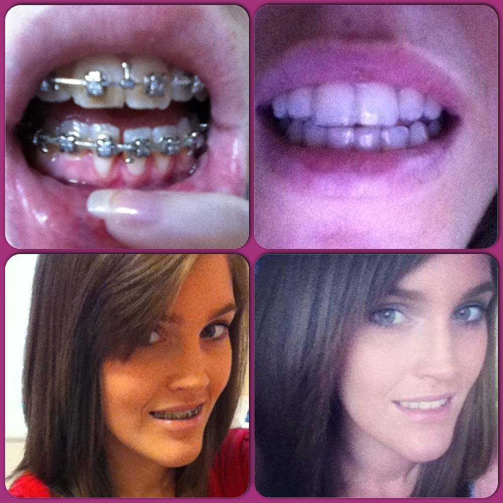 Adult+braces+braces+before+and+after+with+braces+and+without+braces+before+and+after+double+jaw+surgery+orthognathic+surgery.JPG