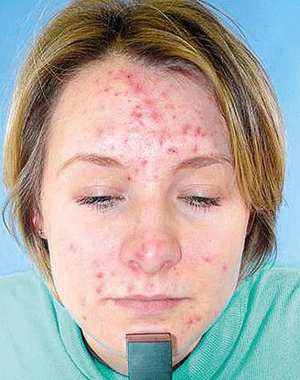 acne scars treatment 5 steps to remove acne scars goodbye acne eliminate acne with a biological skin care cream 300x380 acne scars treatment 5 steps to remove acne scars goodbye acne eliminate acne with a biological skin care cream 300x380