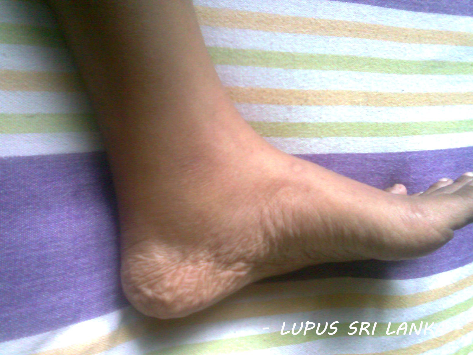 Lupus Sri Lanka