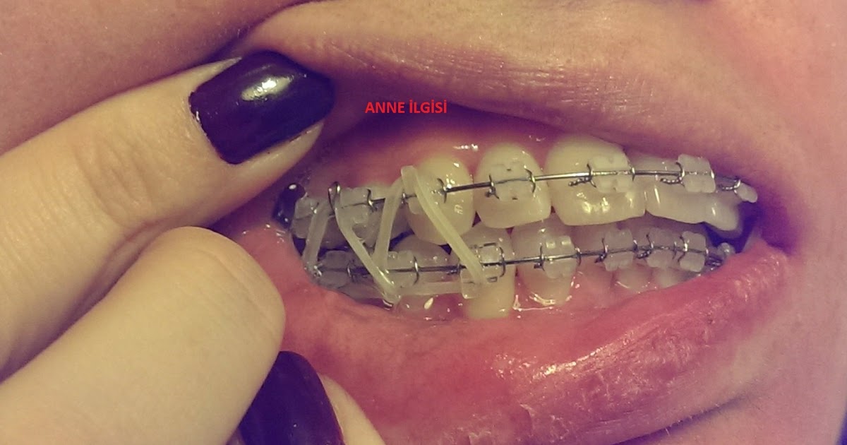 ANNE OLUNCA NEYİ ANLIYORDUK? Diş Teli Lastiği Elastiği
