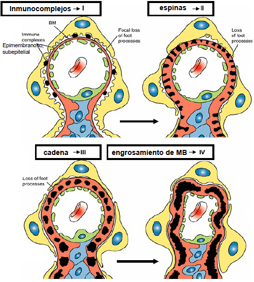 enfermedad de cadenas ligeras pdf patolog 237 a glomerulopat 205 as enfermedad de cadenas ligeras pdf patolog 237 a glomerulopat 205 as