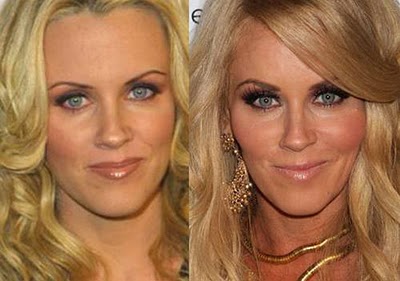 celebrities plastic surgeries