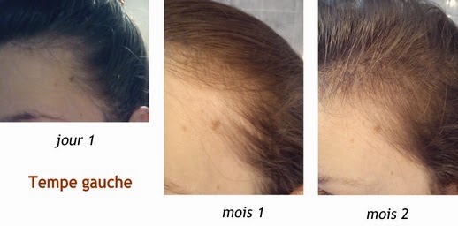 cystine b6 avant apres cystine b6 avant apres