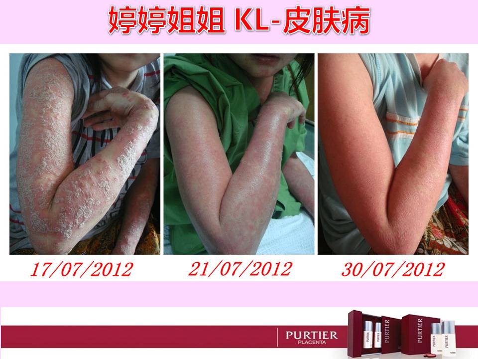 MS TENG TENG (KUALA LUMPUR) - SKIN DISEASE (PSORIASIS/ACZEMA/CUTANEOUS CONDITION)