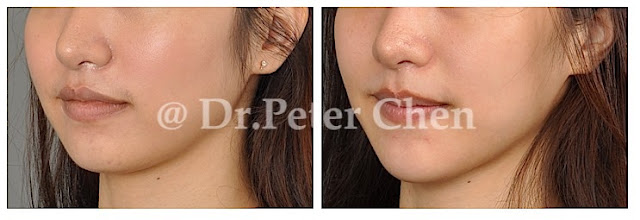 下巴手術,墊下巴