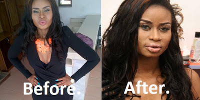 Nigeria Lady Paid $85,000 For Lip Surgery
