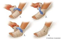  3. Bila lutut dipasang kness dekker, lakukan pembalutan agar keras pada bagian lain