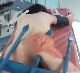  Nữ sinh bị thanh sắt đâm xuyên phần mông vì trốn cha mẹ đi chơi đêm