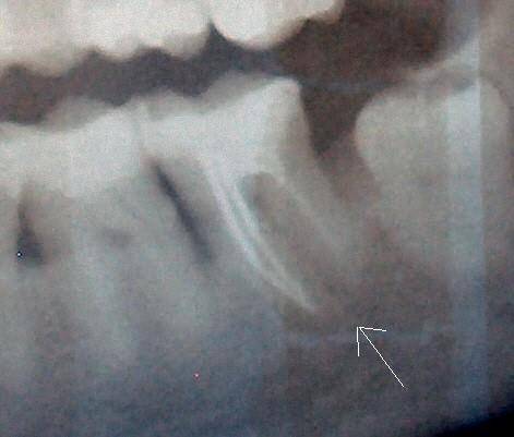 Primary Tooth Abscess