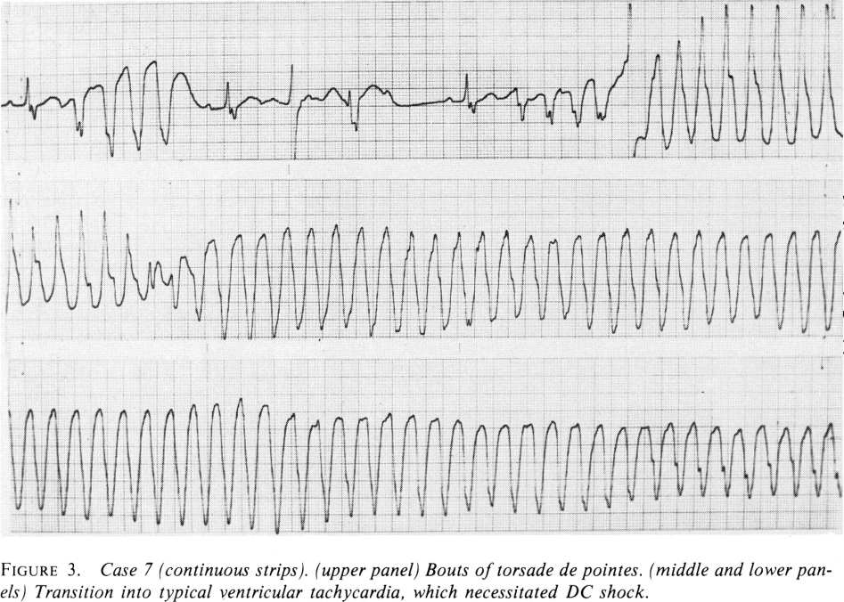 Torsades De Pointes