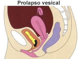 Como Es La Operacion De La Vejiga Caida