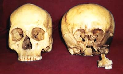 In cursul unor sapaturi arheologice a fost descoperit un craniu neobisnuit, care desi apartinea unui copil prezenta cavitatile creierului neobisnuit de mare. Mister, senzational, extraordinar. Se pare ca acel copil suferea de hidrocefalie, dar ufologii l-au prezentat timp de maimulti ani de zile drept dovada a existentei hibrizilor umano-extraterestrii. Intre adevar si fictiune. Craniul s-a deformat ca urmare a ineiboli foarte rare insa chiar si asa inca mai exista diversi specialisti gata sa afirme faptul ca diferentele dintre un craniu de om si cele ale lui starchild sunt mult prea mari si mult prea neobisnuite 