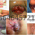Obat Wasir Buat Ibu Hamil Keluar Benjolan di Anus thumbnail