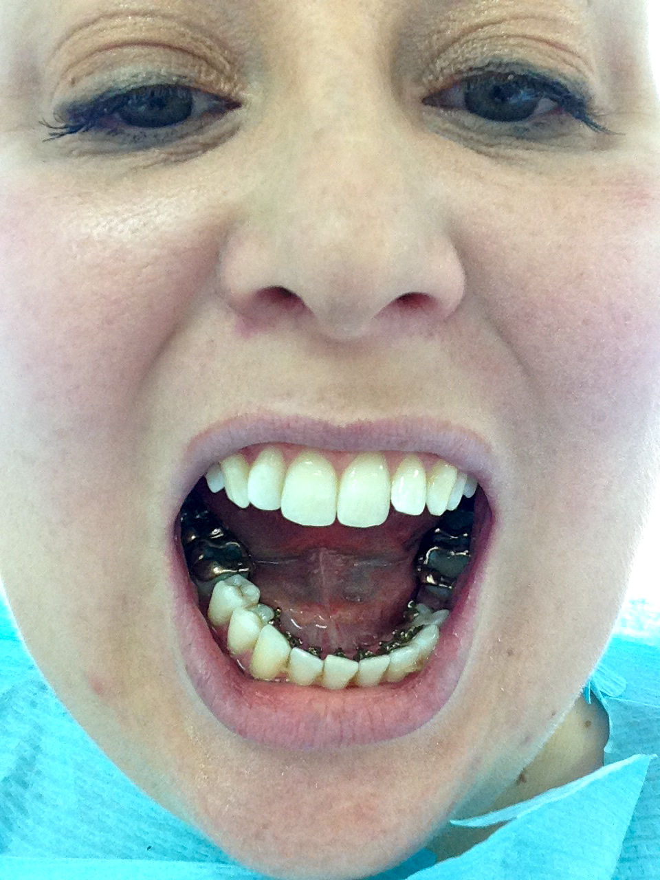 Incognito Braces Update Expat Make Up Addict