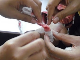 Cara Melepas Kain Kasa Yg Menempel Di Luka Amat