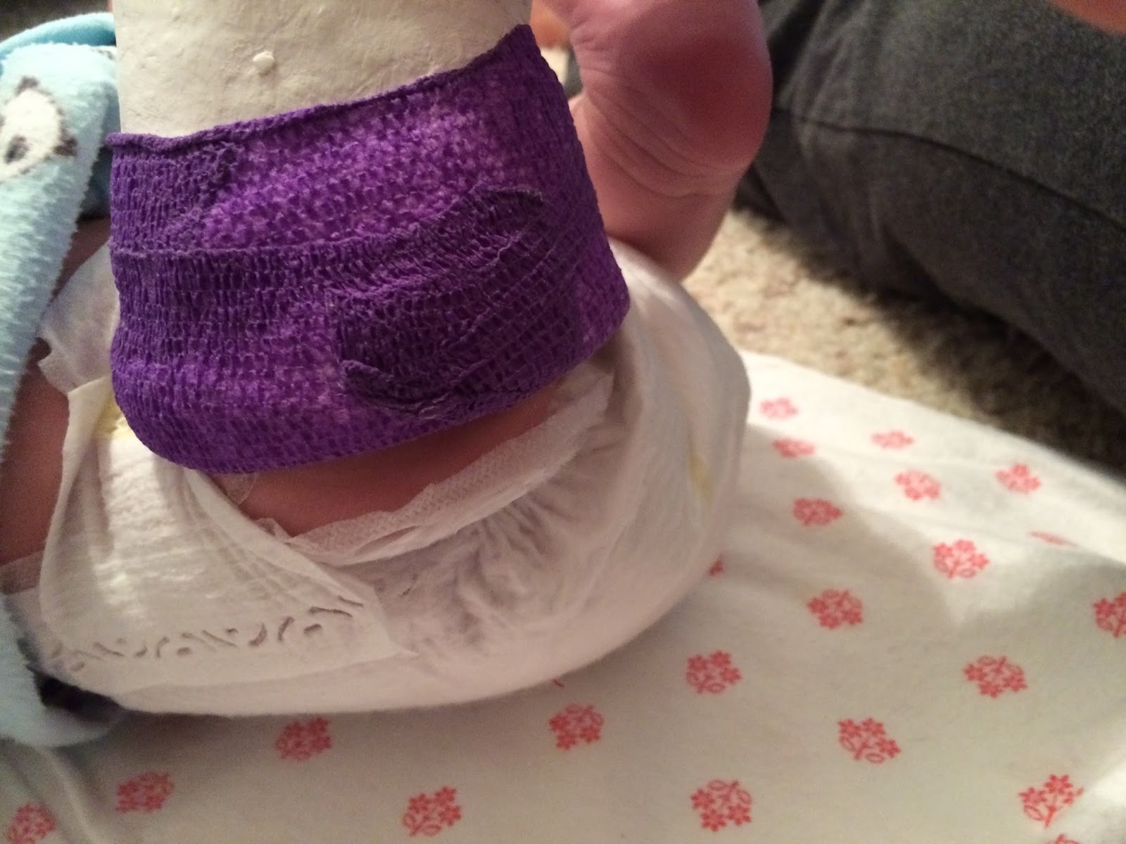 Parents Guide for Clubfoot Babies Phase One Clubfoot Casting