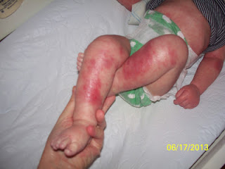 TSW Sindrome de piel roja