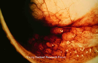 Purulent surgery essays picture