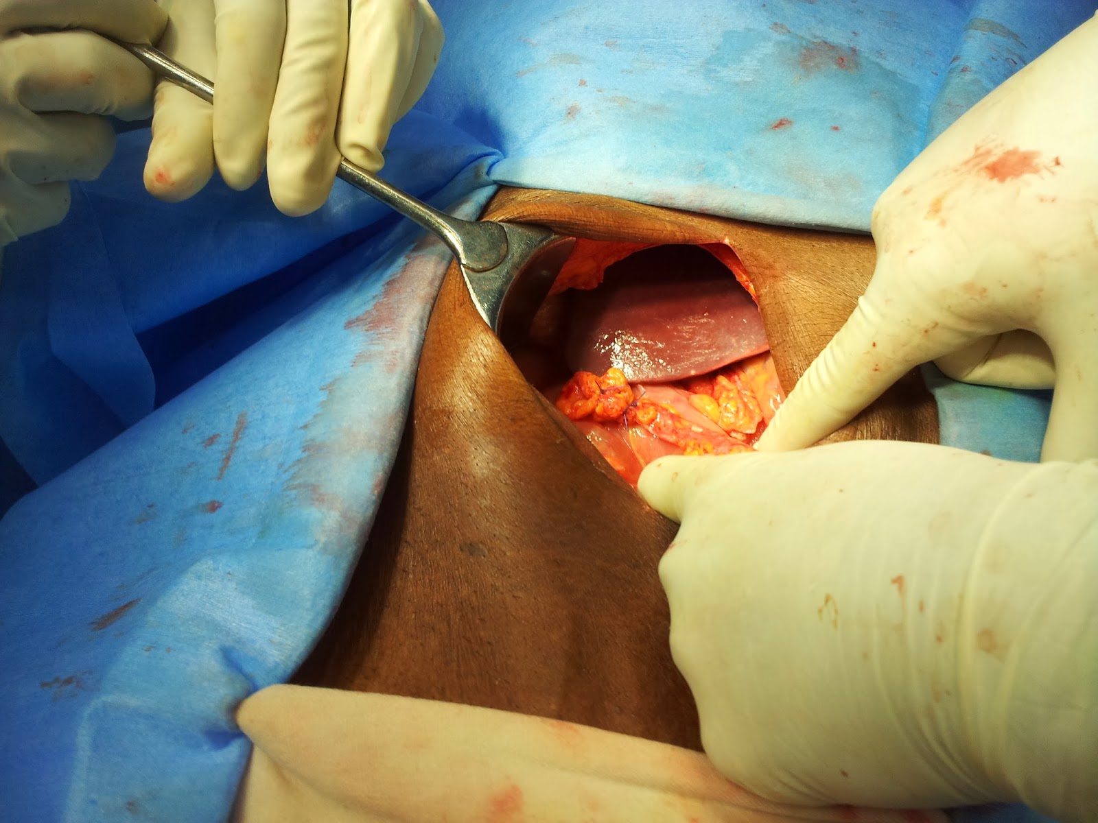 Patch Of Perforated Duodenal Ulcer