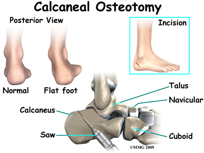 foot surgery flatfoot osteotomy calcaneal deformity acquired arch lengthening lateral column treatment adult flat calcaneus eorthopod tendon ankle bone ligament