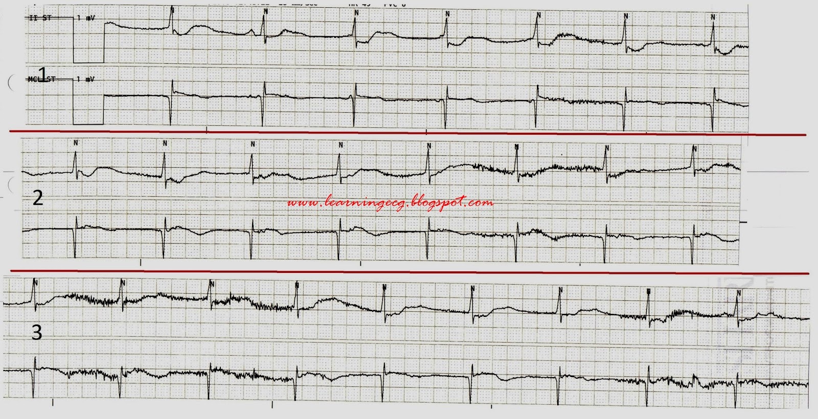 ECG Rhythms Pseudofirst degree AV block