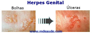 Lesões do herpes genital