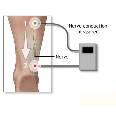do nerve conduction tests hurt