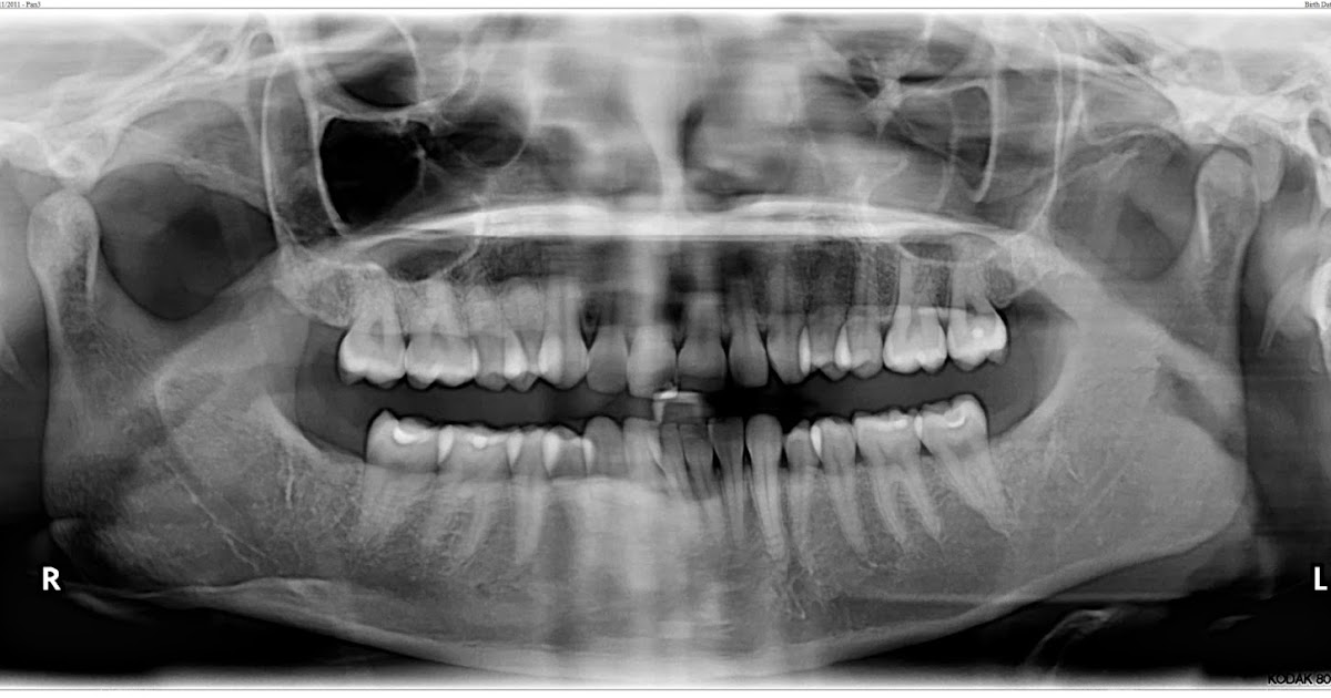 Toronto Invisalign Brand New Smile ) Interproximal Reduction (IPR) for Invisalign in Toronto