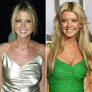 tara reid surgery plastic before botox bad breast wrong implants worse gone boob jobs implant celebrities botched celebrity surgeries famous
