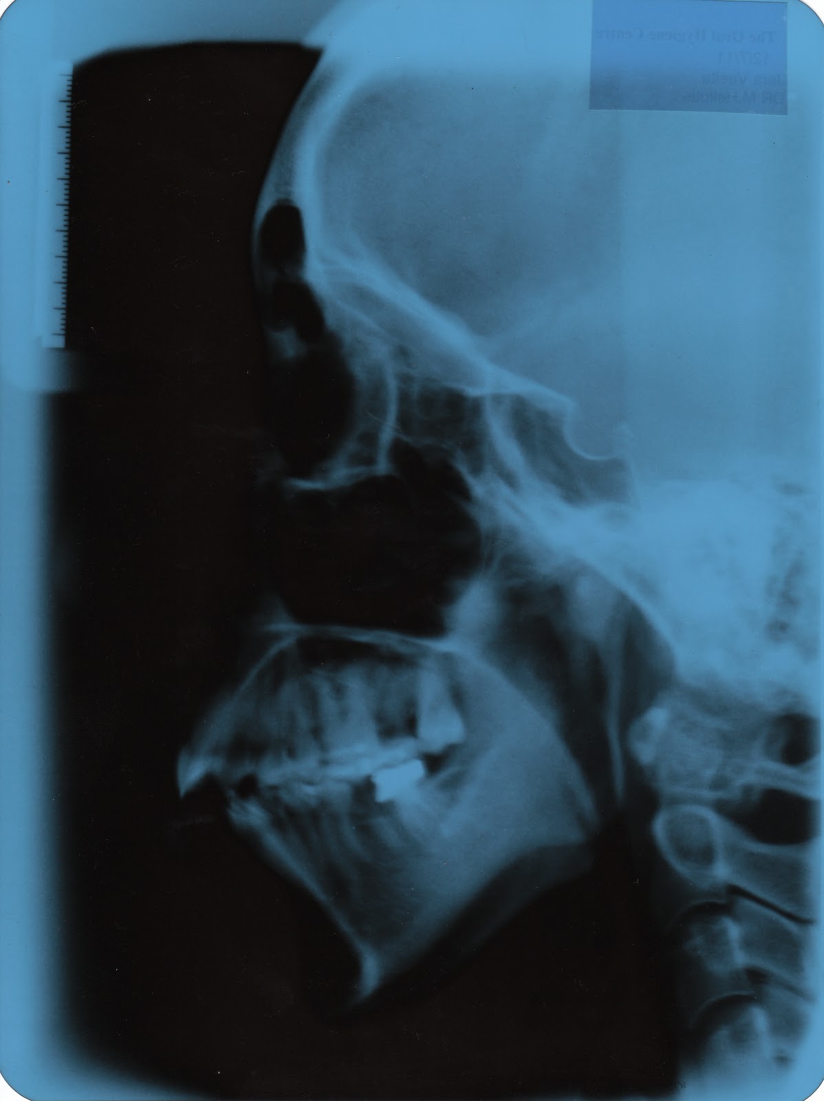 Getting everything straight. My double jaw surgery Xrays