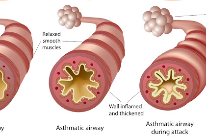 Asthma Attack Information About Asthma Attacks To Be Aware