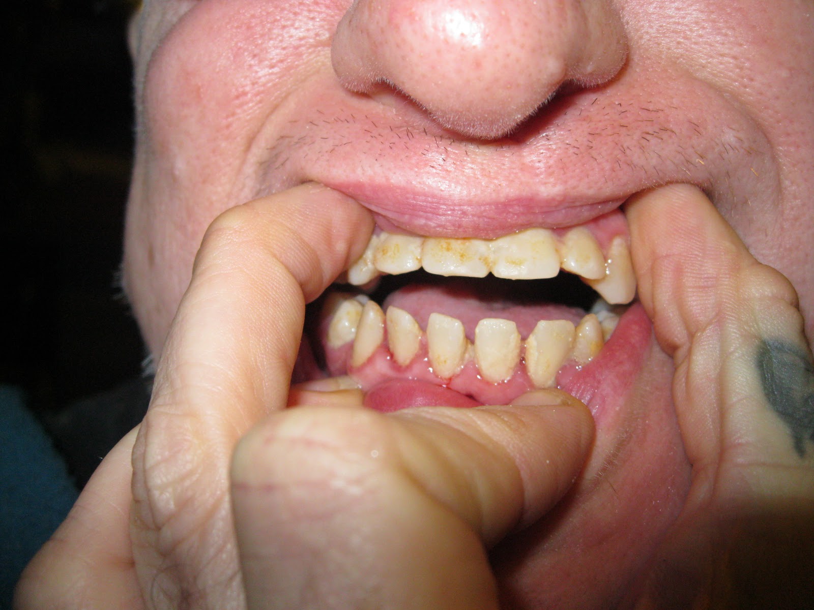 cerebral palsy complications associated medical