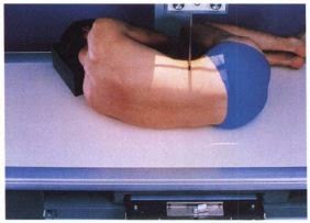 spinal fusion series hyperflexion spinal fusion series hyperflexion