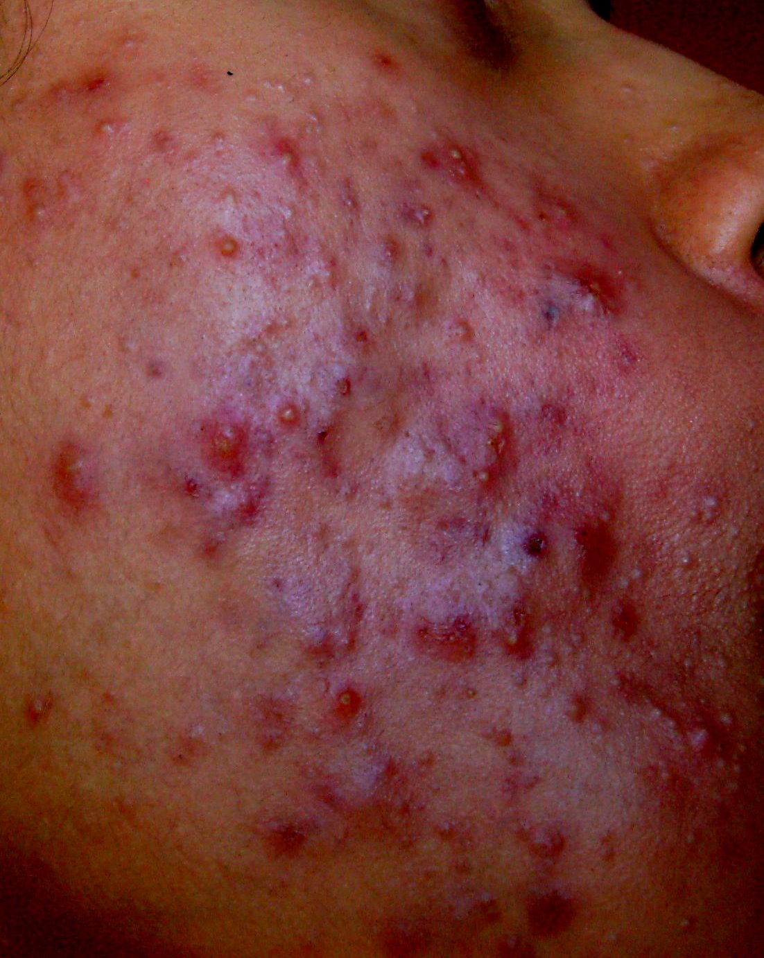 grade 3 acne