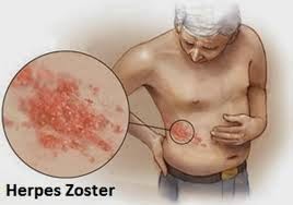 herpes jual obat herpes
